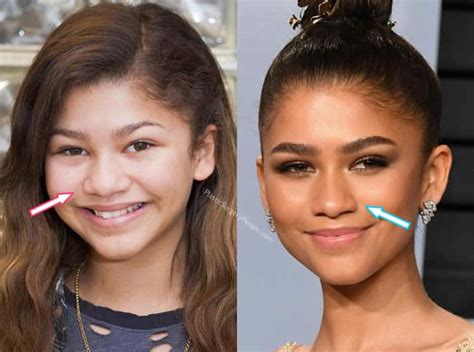 zendaya nose job|zendaya before and after.